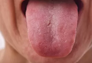Coronavirus: Lesiones en la lengua y manchas en pies y manos podrían ser síntomas de la COVID-19, según estudio