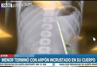 Tarapoto: Médicos retiran arpón incrustado en abdomen de adolescente