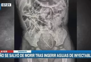 Tarapoto: Niño de 2 años ingirió ocho agujas y médicos salvaron su vida